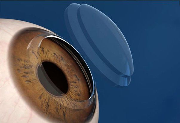 角膜塑形术的临床风险防控指南（2017）