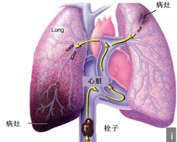 肺栓塞与反常栓塞的关系