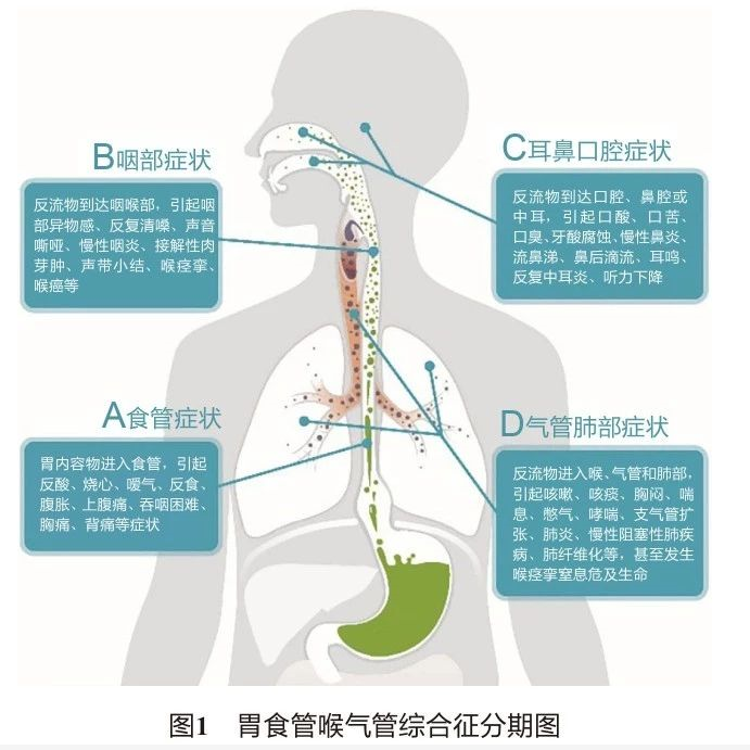 中国胃食管反流病多学科诊疗共识